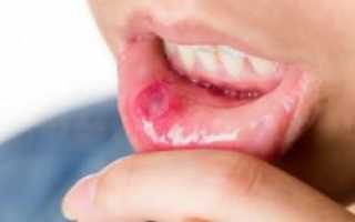 Признаки аллергического стоматита с фото, лечение заболевания слизистой оболочки полости рта у детей и взрослых