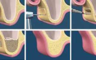 Что такое синус-лифтинг в стоматологии: открытый и закрытый тип операции, осложнения, рекомендации