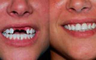 Как выглядят протезы «бабочка» во рту при отсутствии 1-2 зубов: фото до и после микропротезирования