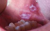 Лейкоплакия слизистых оболочек полости рта и языка — что это такое: симптомы с фото и лечение