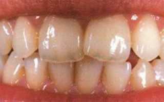 Что делать, если зубы на кончиках стали прозрачными: причины, лечение и профилактика