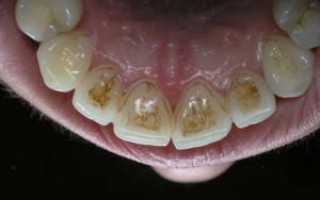Почему зубы чернеют изнутри и снаружи, что делать при потемнении эмали у взрослых и детей?