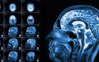 Как подготовиться к МРТ сосудов мозга и головы с контрастом или без, что нельзя делать пациенту перед исследованием?