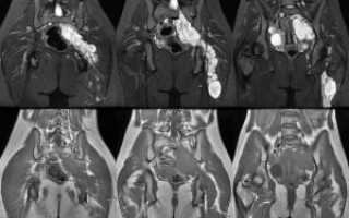 Что показывает МРТ-исследование органов малого таза у женщин: подготовка и расшифровка томографии