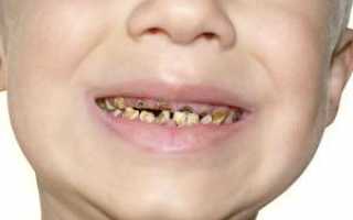 Почему у ребенка в полтора-два года гниют молочные зубы: как быть и что делать родителям?