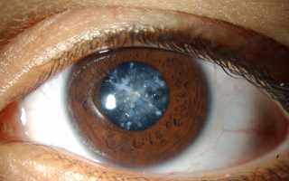 Как лечить катаракту без операции?