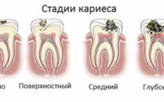 Диагностика начального кариеса и лечение зубов в стадии белого пятна на эмали