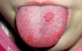 Жжение на языке и во рту: причины — почему кончик языка красный и болит, как будто обожгла, и как лечить?