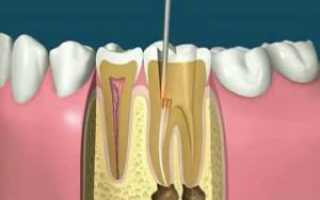Как выглядит на фото зубной нерв и как его удаляют — методы эндодонтического лечения зубов: видео процедуры
