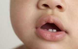 Сыпь у ребенка во время прорезывания зубов: может ли этот процесс вызвать аллергию и что такое цитокиновый взрыв?