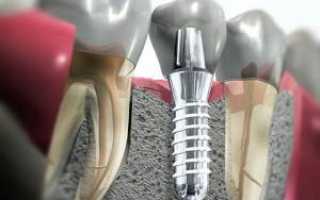 Может ли после установки штифта болеть зуб без нерва, как избавиться от боли при надавливании?
