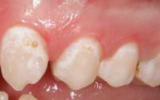 Кариес в стоматологии: причины, симптомы и стадии развития с фото, лечение зубов