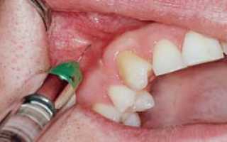 Метод интралигаментарной анестезии в стоматологии — особенности и противопоказания