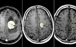 Как опухоль головного мозга выглядит на снимках МРТ, как проводится диагностика злокачественных образований?
