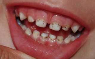 Причины налета на зубах у ребенка: почему появляются черные, желтые и коричневые пятна в возрасте 1-3 лет?