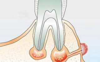 Причины и лечение свища на десне (дырки во рту) после удаления зуба или имплантации
