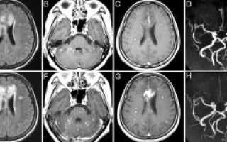 МРТ-диагностика головного мозга для определения признаков рассеянного склероза: исследование с контрастом и без