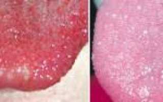 Все о черном «волосатом» языке: симптомы заболеваний и причины темного налета (пятен) во рту у взрослого человека