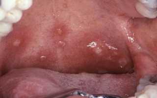 Лечение инфекционного вирусного стоматита у взрослых при простуде, фарингите и после гриппа