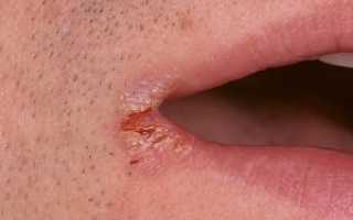 Как быстро вылечить заеды в уголках губ у взрослых: причины и лечение ангулярного стоматита в домашних условиях