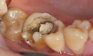 Сколько можно ходить с мышьяком в зубе взрослому и ребенку, и что делать, если нерв все равно болит?