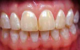 Что такое оскомина на языке и зубах: причины неприятного ощущения во рту и лечение оскомы в домашних условиях