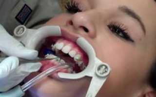 Как ставятся брекеты на зубы, больно ли это: видео и описание процедуры, подготовка к установке