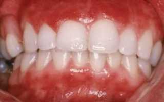 Чем лечить воспаление десны около зуба в домашних условиях и как быстро снять опухоль: народные средства