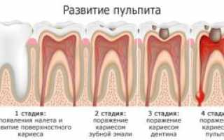 Выбор метода лечения пульпита зуба: хирургический, биологический или девитализирующий (с применением паст)