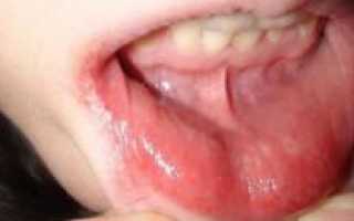 Болячка на слизистой с внутренней стороны губы в виде белой язвочки или пятна, но не герпес: как лечить гнойник?