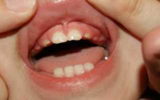 Прорезывание клыков — где находятся глазные зубы и когда они режутся у детей: симптомы с фото