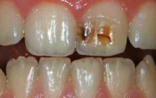 Некариозные поражения зубов, возникающие до или после прорезывания единиц
