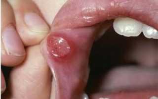 Заболевания языка и полости рта: фото и названия болезней слизистой оболочки у взрослых, способы лечения