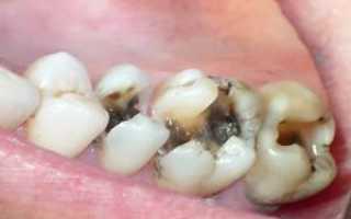 Проблема плохих зубов у взрослых: список заболеваний и фото с описанием основных зубных болезней
