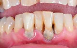 Периодонтиты и их классификация: симптомы с фото, лечение зуба антибиотиками в домашних условиях и народными средствами