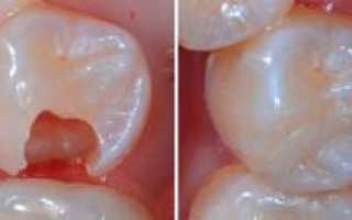 Сколько времени после пломбирования зуба нельзя есть, и когда можно кушать после установки световой и временной пломбы?