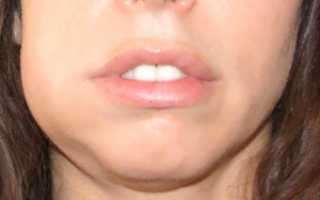 Флюс зуба и опухоль на щеке: что делать и чем лечить, если внутри десны гной и щеку раздуло?