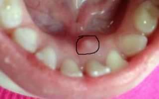 Лечение шишки на языке или под ним — кисты слюнной железы, травмы или злокачественного образования