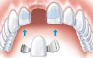 Установка временных протезов на верхнюю и нижнюю челюсть после удаления передних или других зубов