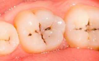Зуб после пломбирования реагирует на холодное и горячее: почему после лечения кариеса повышается чувствительность?