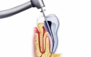 Как чистят зубные корневые каналы: обработка, обтурация и другие основы эндодонтического лечения