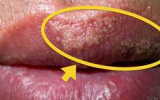 Фото болезни Фордайса: причины пятен на губах, симптомы и лечение заболевания