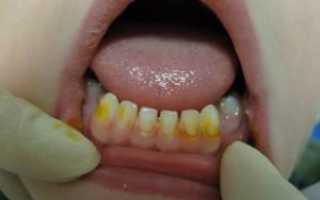 Зачем нужно посеребрение молочных зубов у ребенка: в каких случаях применяется данный метод и что говорит Комаровский?