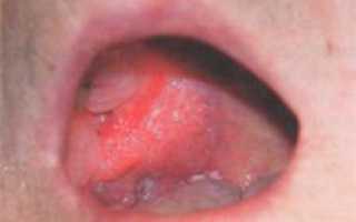 Проявления туберкулеза слизистой оболочки полости рта и языка — фото симптомов и лечение