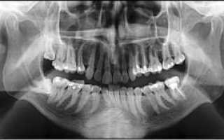Рентген верхней и нижней челюсти: как правильно и насколько часто можно делать снимок зубов?