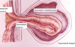 Что такое грыжа в кишечнике: симптомы и лечение