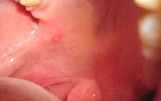 Белые прыщики на внутренней стороне губы во рту: причины и лечение у детей и взрослых