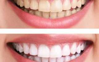 Что такое отбеливание Zoom 3, сколько держится эффект от процедуры: реальные фото зубов до и после