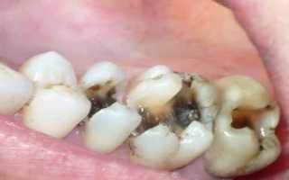 Понятие перфорации корня зуба: причины возникновения, симптомы, лечение и последствия
