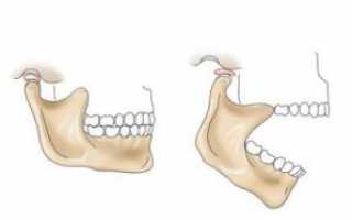 Почему при открытии рта и когда жуешь может болеть челюсть возле уха, каковы сопутствующие симптомы и что делать?